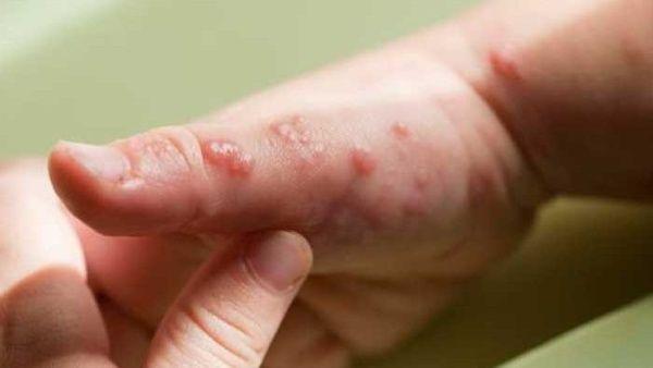 92 casos de viruela de mono en 12 países