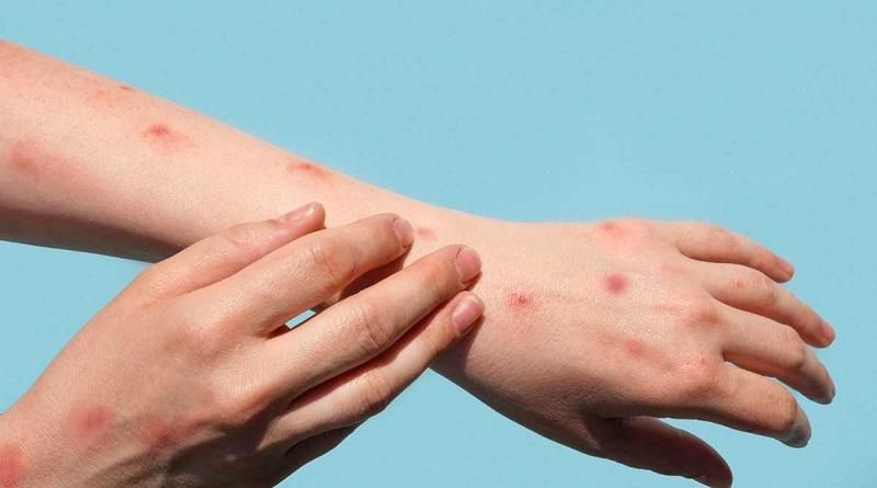 Confirman más de dos mil casos de viruela símica en 42 países