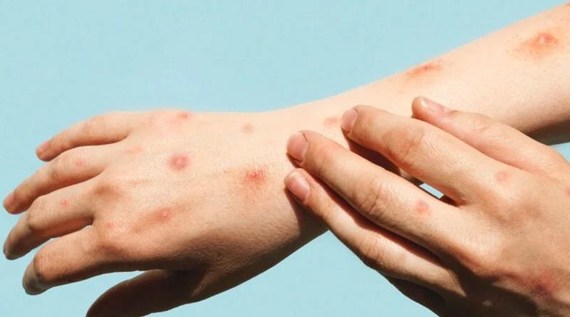 Comunidad médica descarta que la MPOX cause pandemia global