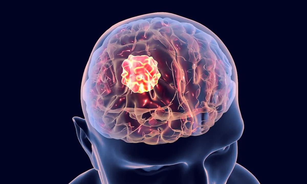 Crean bioparche capaz de eliminar células del tumor cerebral más letal
